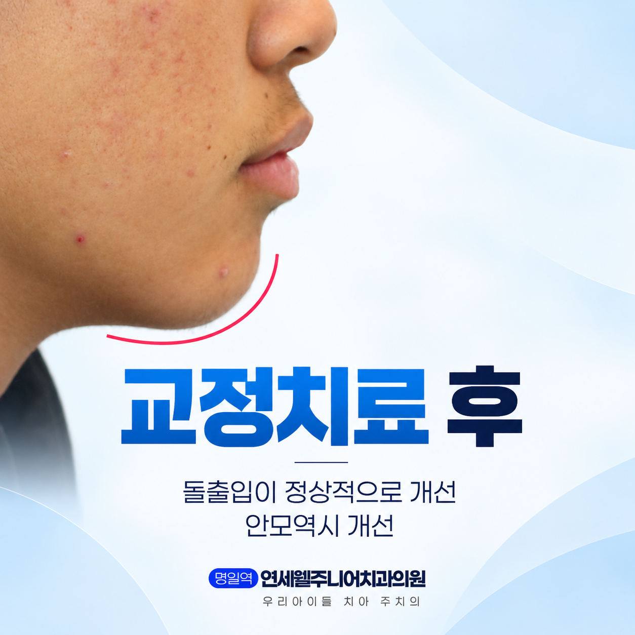 중학생 치아교정 후 입술 돌출 정도와 턱선 변화를 보여주는 측면 사진
