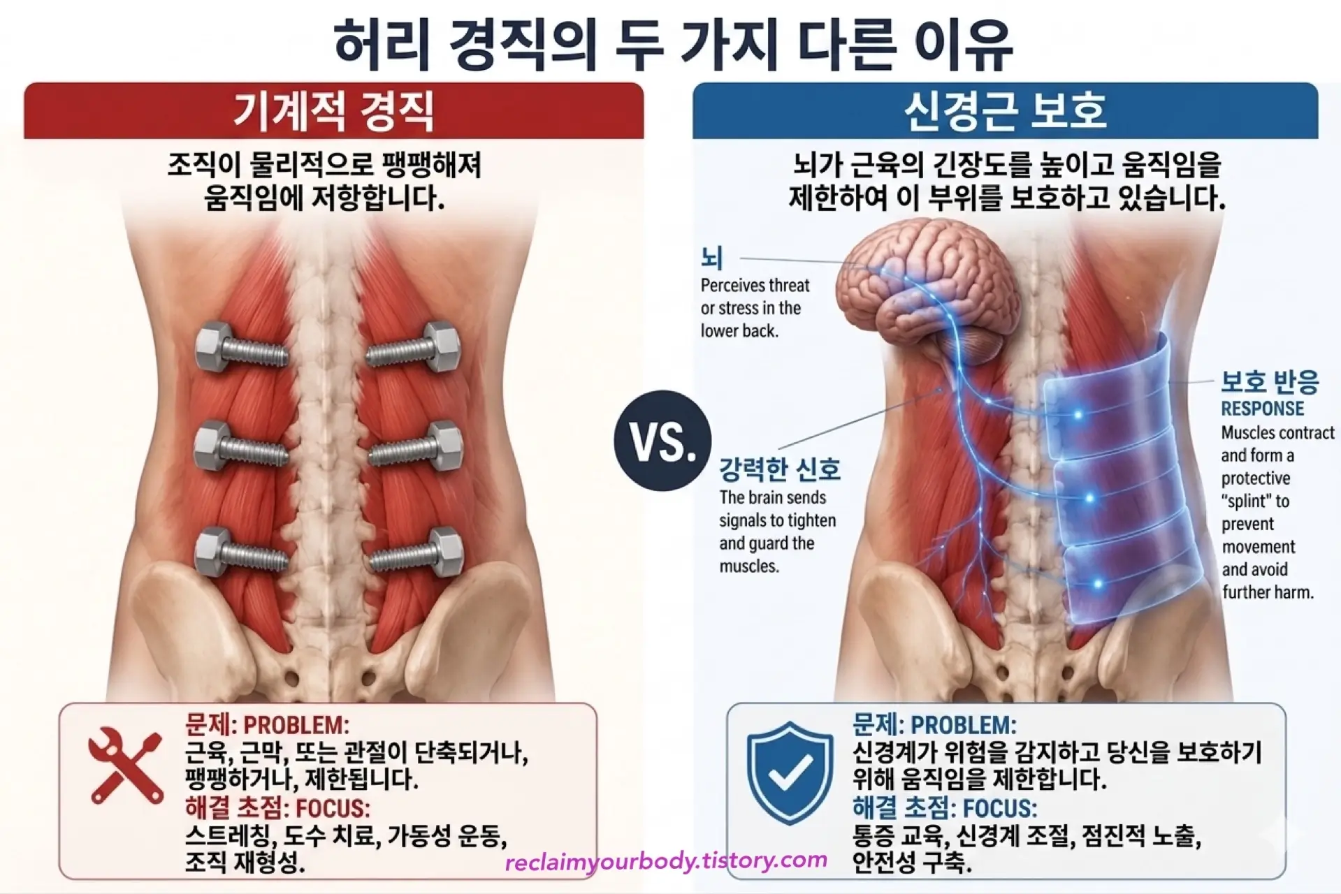허리 경직의 두 가지 원인인 기계적 경직(Mechanical stiffness)과 신경근 보호(Protective muscle guarding) 반응을 비교하는 의학 일러스트레이션 구조도