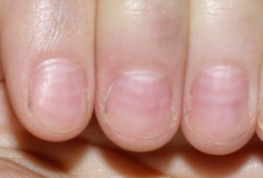 가로줄이 생긴 손톱
