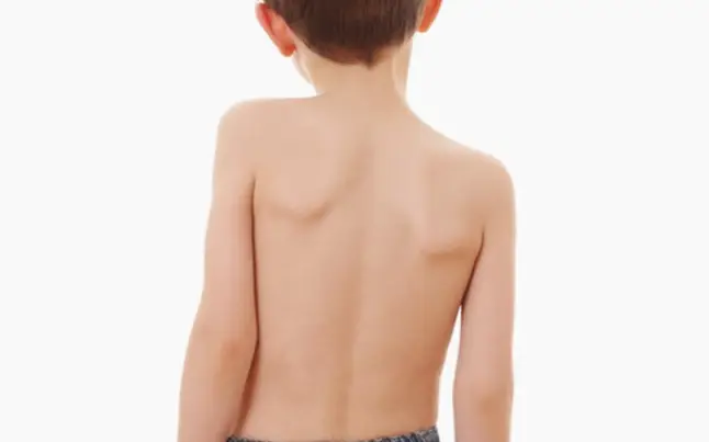 척추 측만증 증상