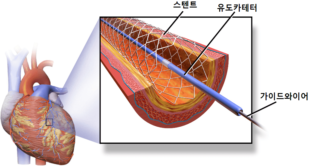 Percutaneous coronary intervention 경피적관상동맥중재술