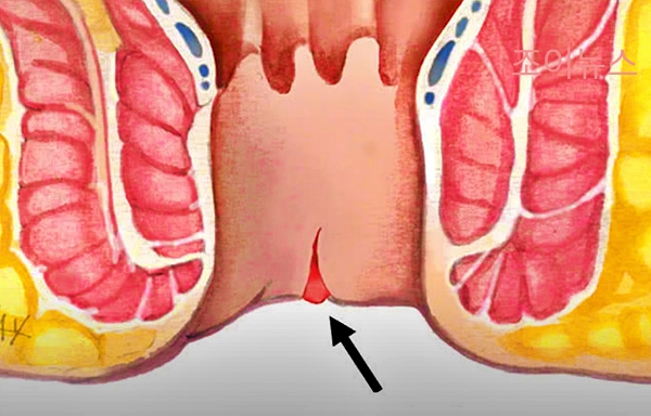 치열_출처:유튜브응꼬형