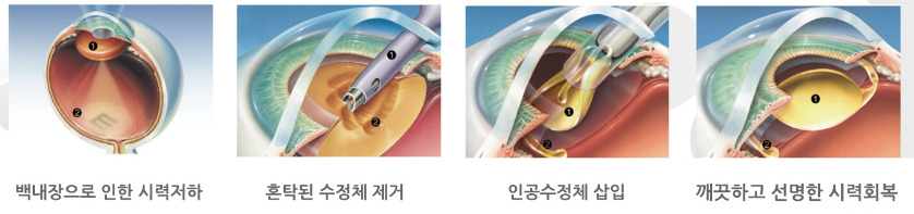 백내장 증상