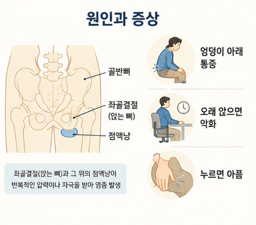 좌골결절 주변 점액낭의 위치와 오래 앉을 때 심해지는 좌골 점액낭염 증상을 설명한 이미지