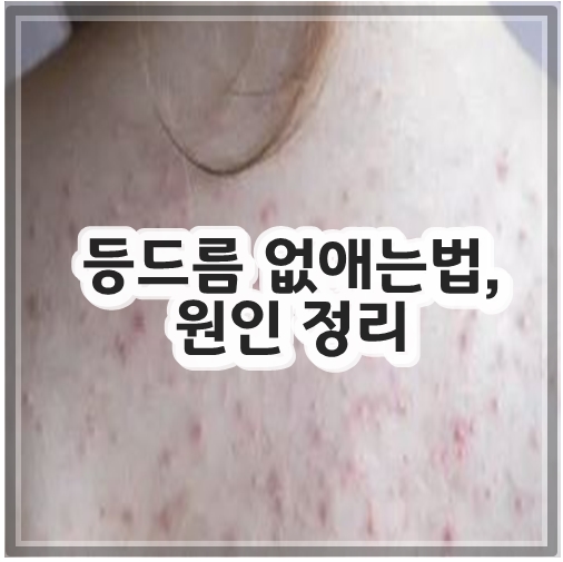 등드름 없애는법, 원인 정리