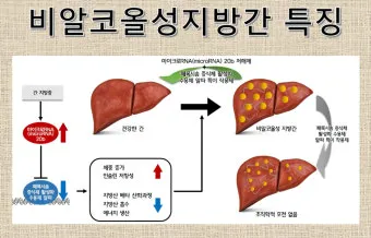 비알콜성 지방간 없애는 방법 운동 식단 중심 회복법 정리_22