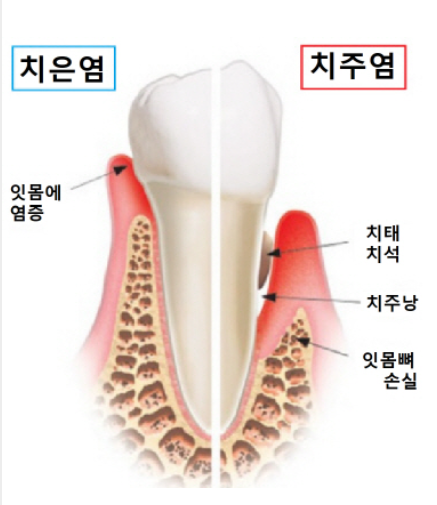 잇몸에 염증이 생긴 치은염과 증상이 심해진 치수염