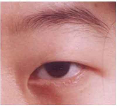 삼백안 눈