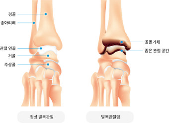 발과 발목 통증