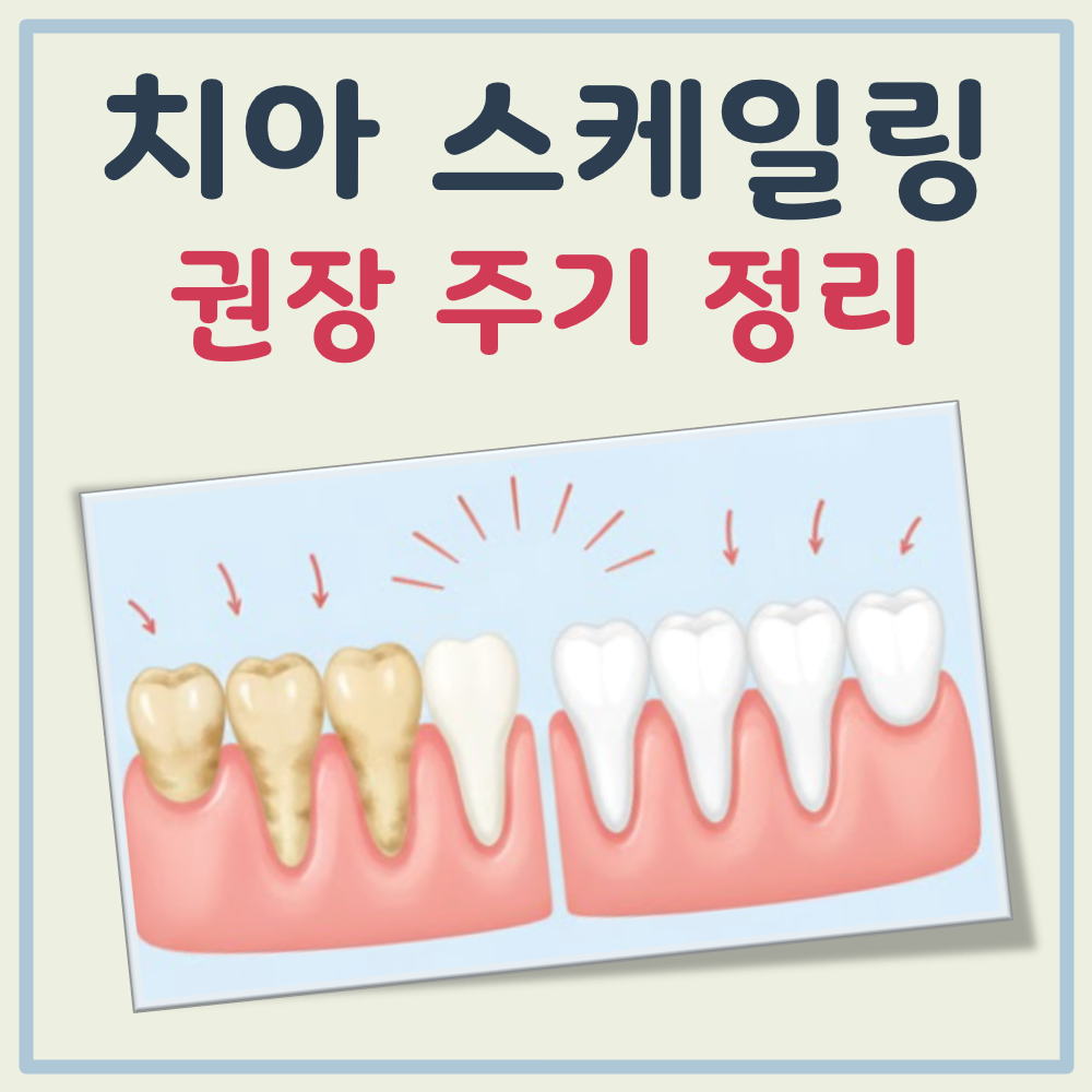 치아 스케일링 주기 대표 이미지