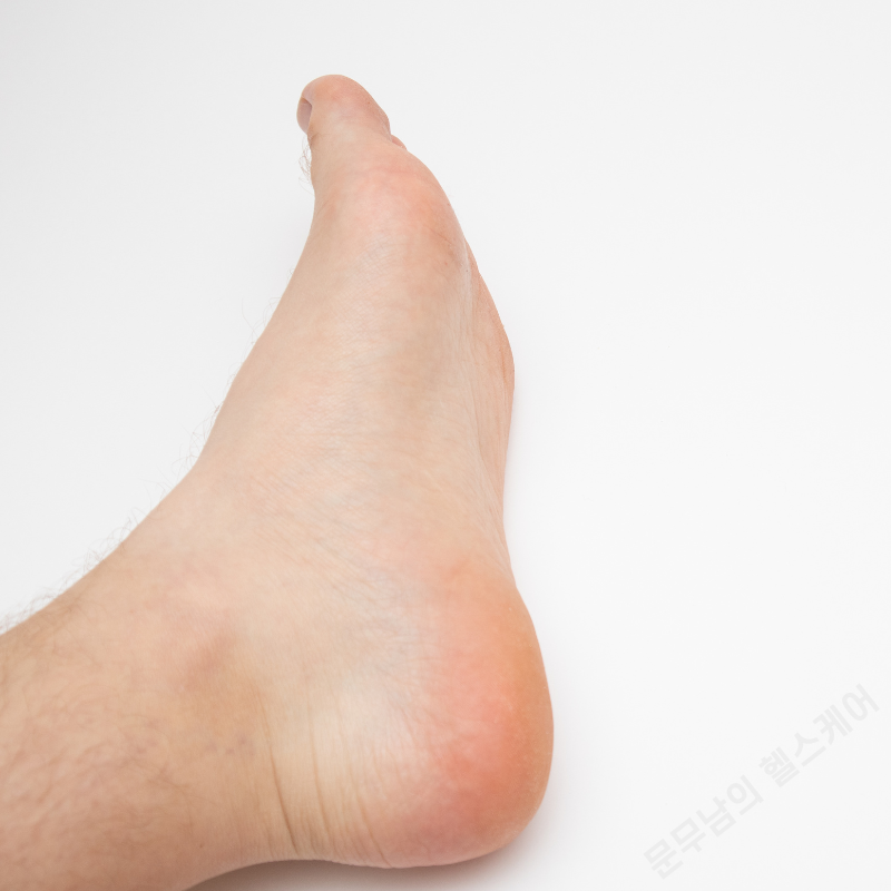 평발 발바닥 통증