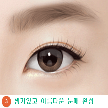 비절개 상안검 수술과정 세번째