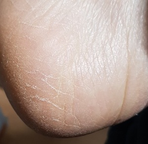 발뒤꿈치-갈라짐-통증