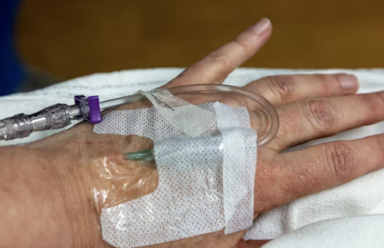 급성구획증후군 근육 허혈 기전 단계