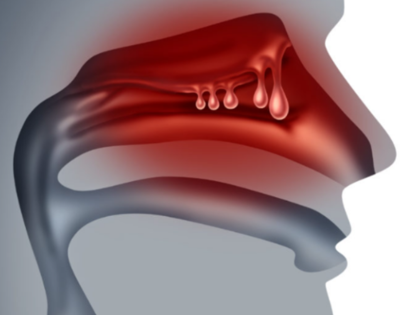 슈다페드정 효능