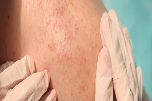 알레르기-피부염