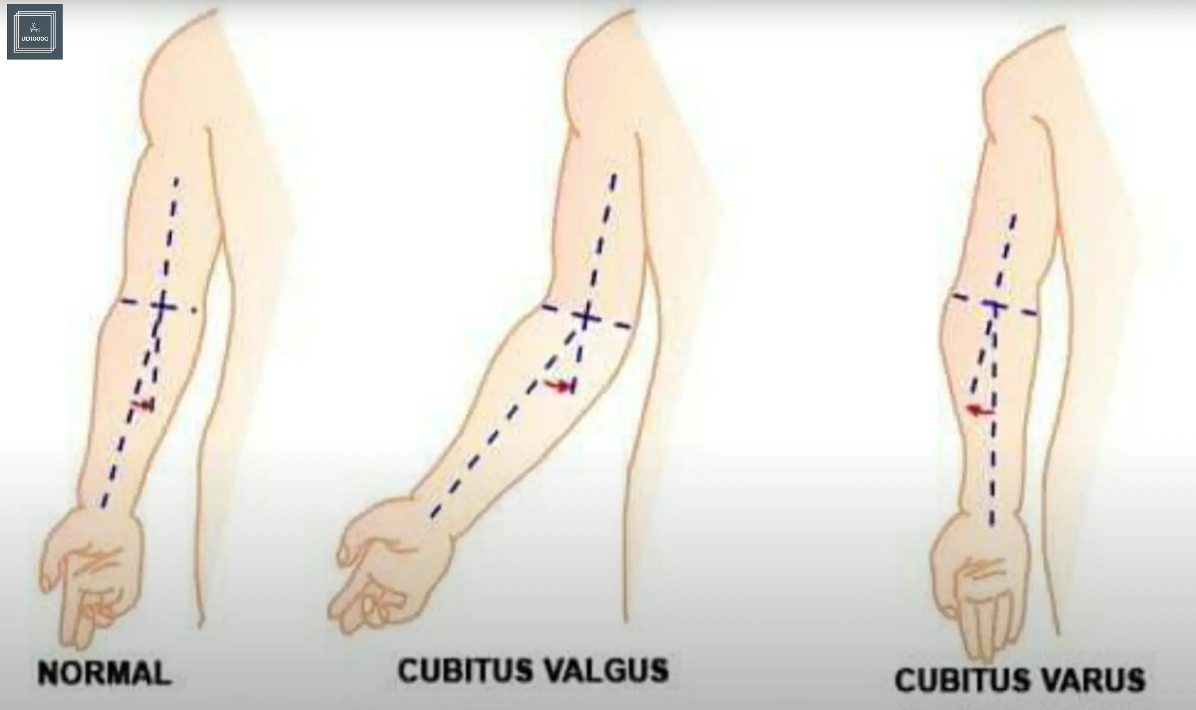 팔꿈치각도확인