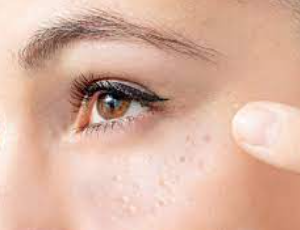 비립종 생기는 이유