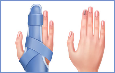 손톱-검은줄-외상