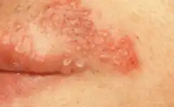 단순포진-입술-이미지