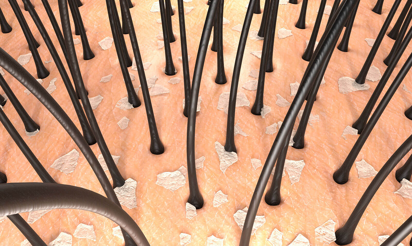 지루성 두피 트러블과 탈모의 관계, 관리법까지 한 번에 정리