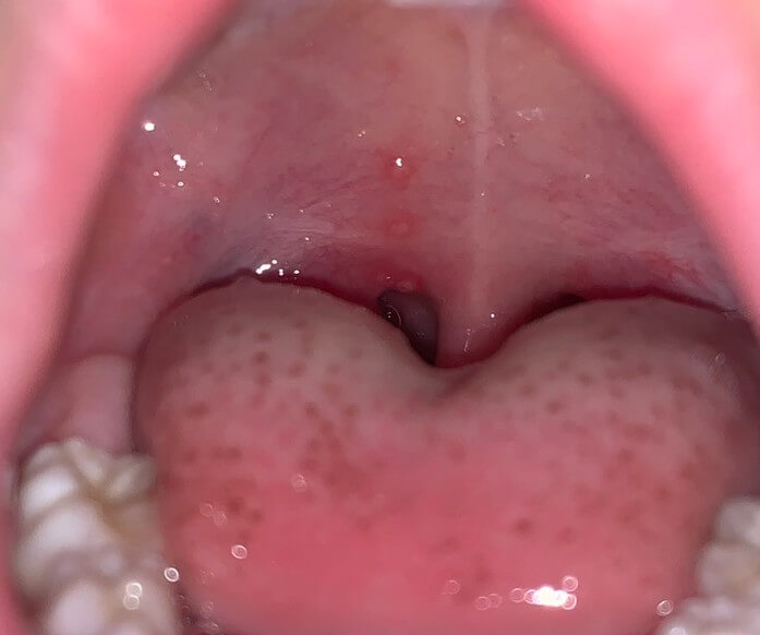 입안에 생긴 구내염