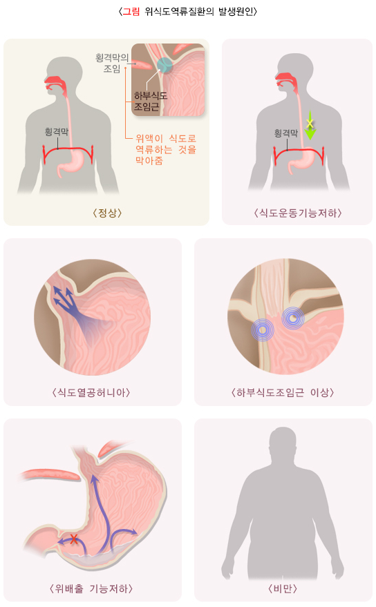 위식도역류질환 관련 이미지