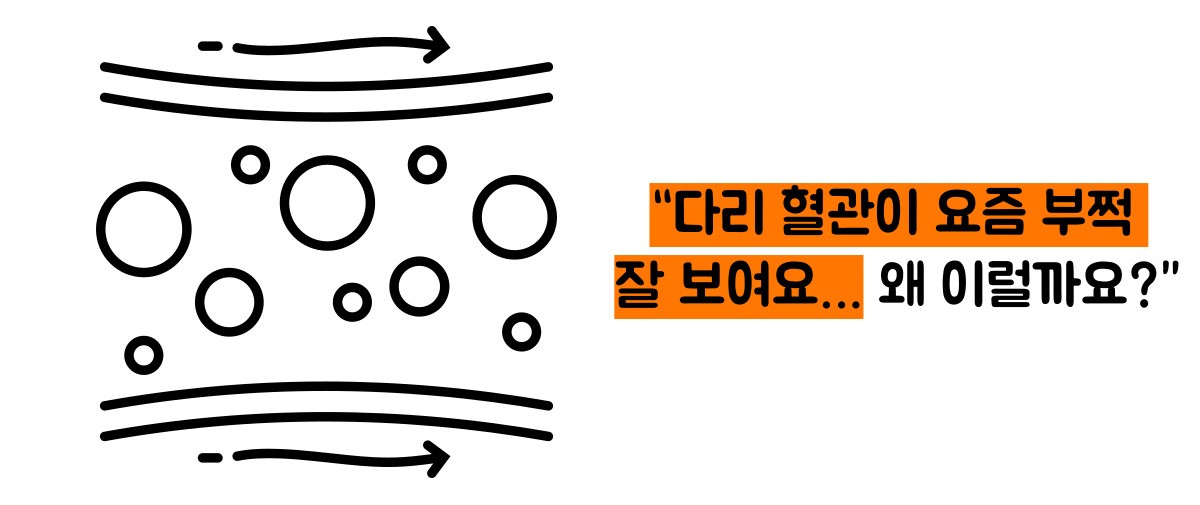 하지 정맥류 증상