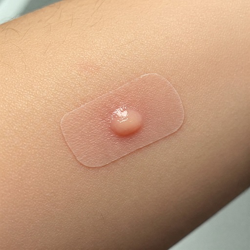 피부 반응 검사