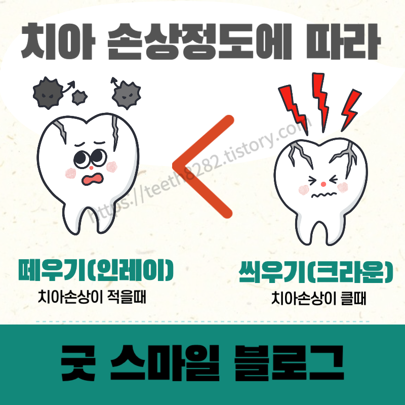 치아크라운-이란?