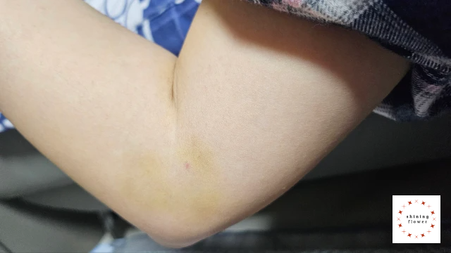 골프엘보-주사 및 물리치료 후 오른팔 사진