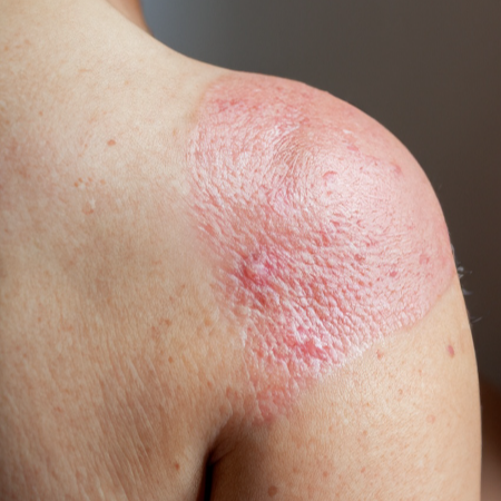 3. 두드러기의 종류