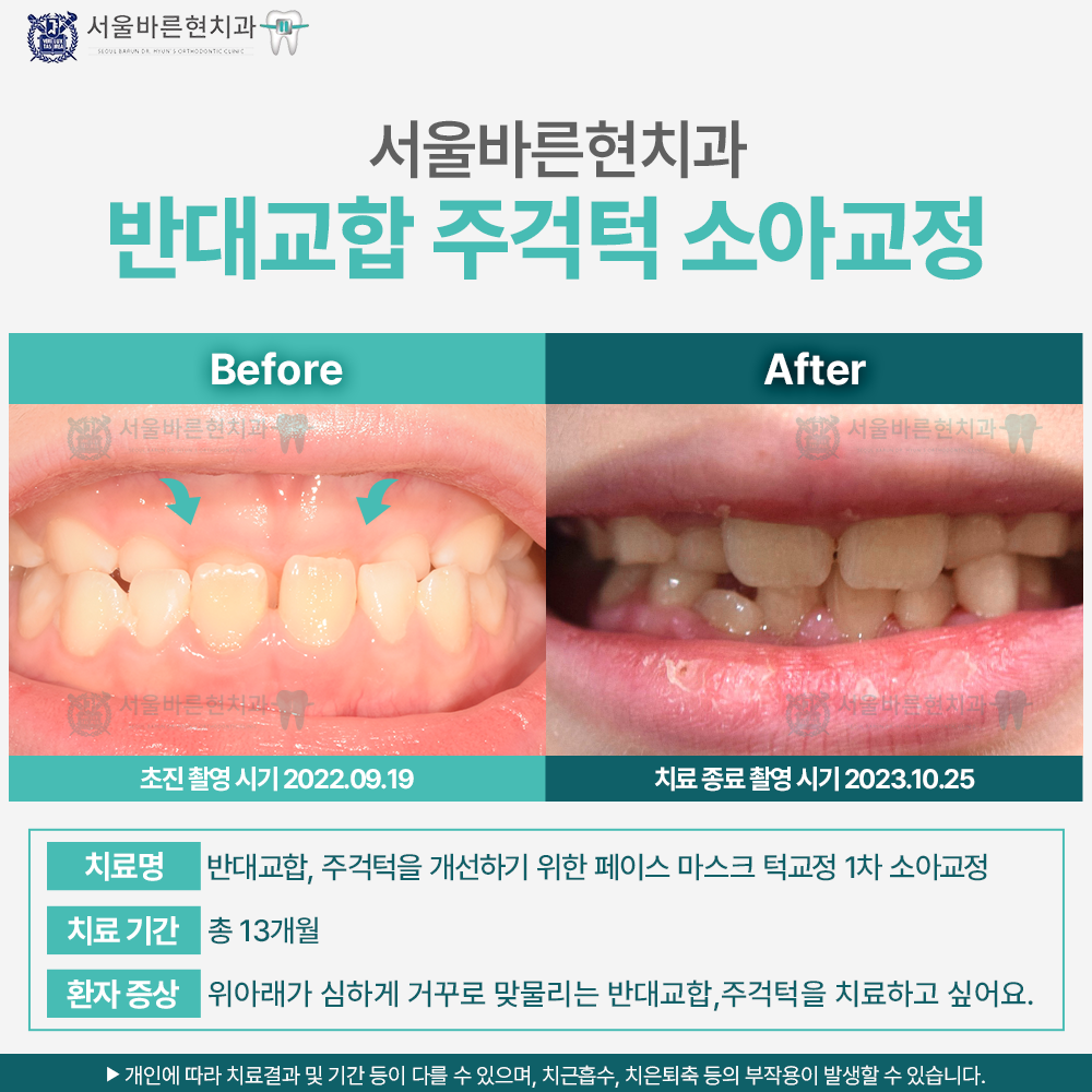 마린시티소아교정