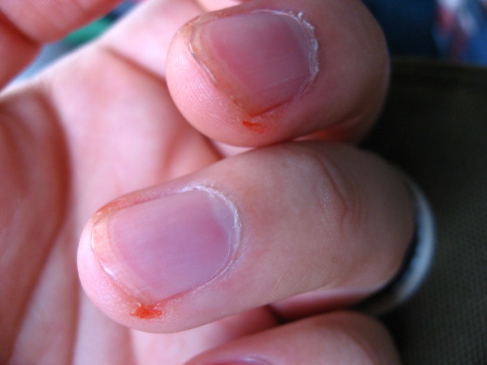 손톱에 피나는 사진입니다.