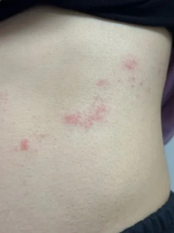 경기도 대상포진 무료접종 연령 기준 정리로 안내_15