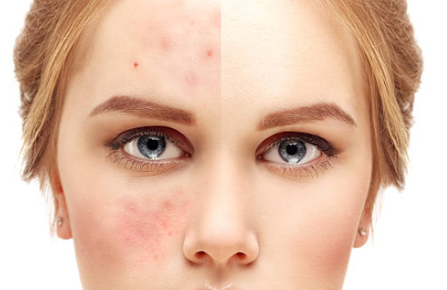 여드름 화장품