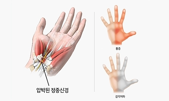 손목 통증 완화 운동