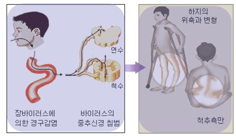 폴리오-소아마비-원인