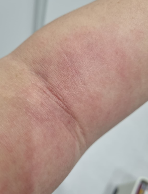 ์ป์ฌ๋์ ๋ ์ฆ์๋ถํฐ ์น๋ฃ๊น์ง, ์ ๋ ํ์ง ๋ง์์ผ ํ ํ๋์?