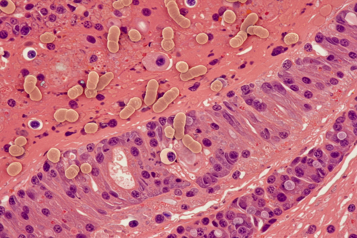 헬리코박터 균 약