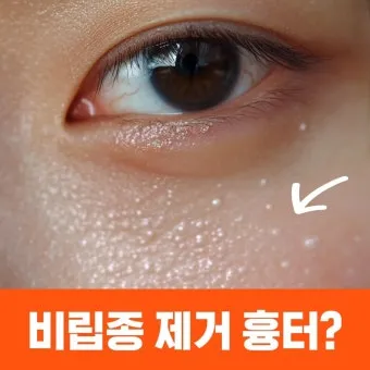 비립종 생기는 이유 비립종 없애는 방법 피부 관리법_10