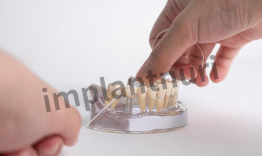 덴티스 임플란트 가격