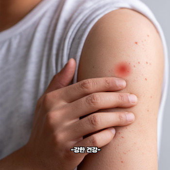 스키터 증후군 증상