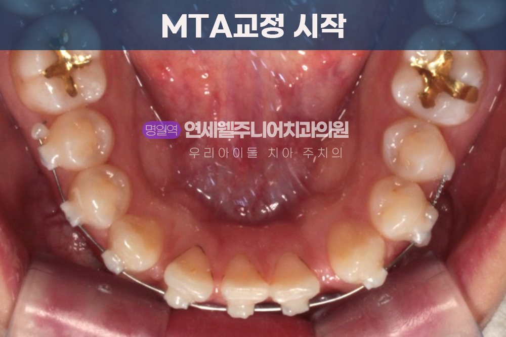 MTA 교정치료 시작단계 하악 치열