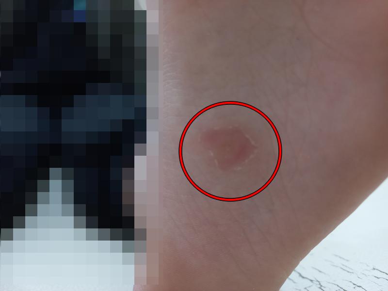 굳은살 냉동치료 6주차