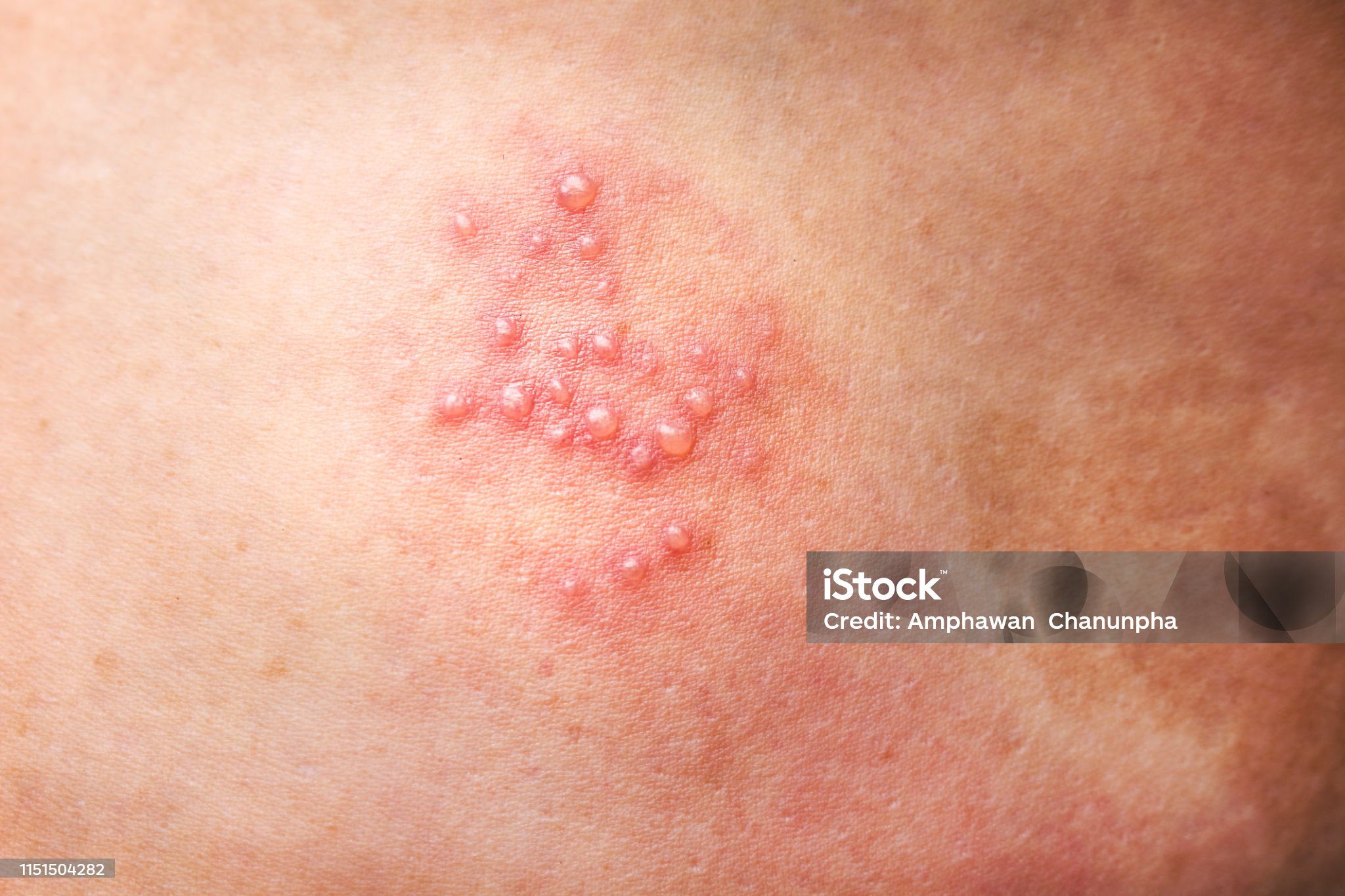 대상포진 자가진단