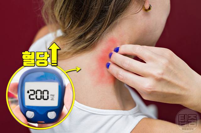 당뇨 증상 열감 가려움증 당뇨 걸리는 식습관