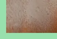 땀띠 원인과 증상 &amp; 치료