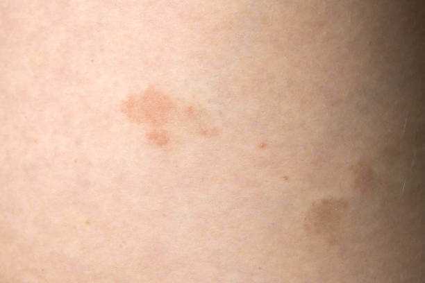 장미색 비강진 원인&amp;#44; 치료&amp;#44; 재발 등에 대해 알아봤습니다. 장미색 비강진은 pityriasis rosea이라고 불리는데요. 어떤 증상과 원인 치료가 있는지 꼼꼼히 읽어보세요! 