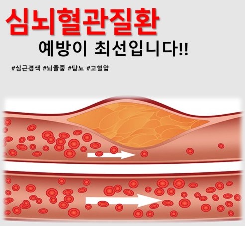 심뇌혈관질환-예방하라는-그림